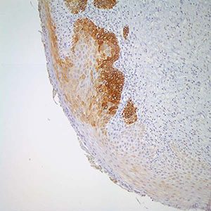 Cytokeratin 17