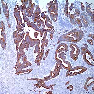 Cytokeratin 20