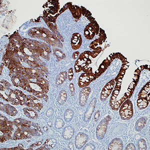 Cytokeratin 20