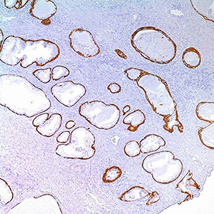 Cytokeratin 5