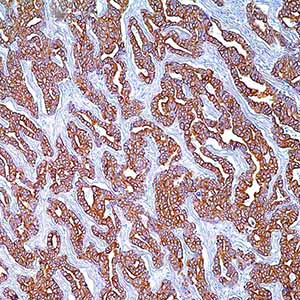 Cytokeratin cocktail AE1 & AE3