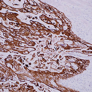 Cytokeratin cocktail AE1 & AE3