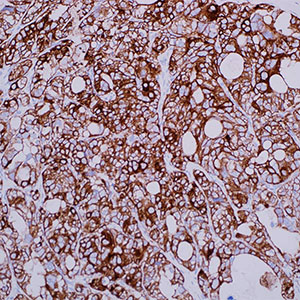 Cytokeratin cocktail AE1 & AE3