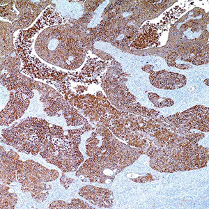 Cytokeratin HMW