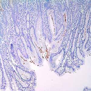 Helicobacter pylori