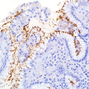 Helicobacter pylori