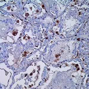 Herpes Simplex Virus II