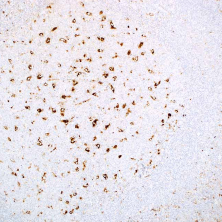 A-1-Antichymotrypsin
