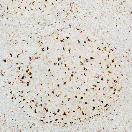 A-1-Antichymotrypsin
