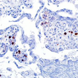 Parvovirus B19