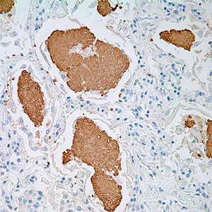 Pneumocystis jirovecci (carinii)