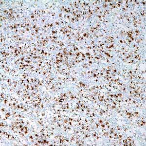 Renal Cell Carcinoma