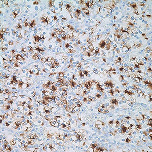Renal Cell Carcinoma
