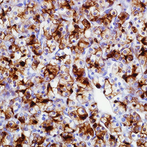Renal Cell Carcinoma