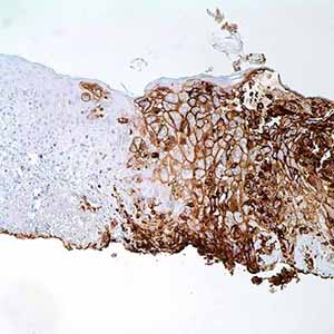 Varicella Zoster Virus