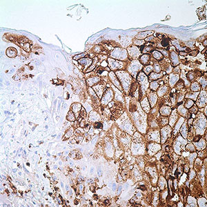Varicella Zoster Virus