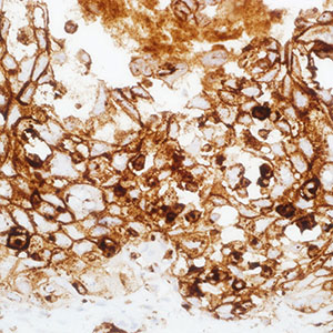Varicella Zoster Virus