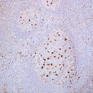 A-1-Antitrypsin