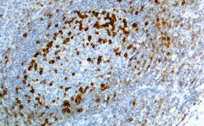 PD-1 (PDCD1)