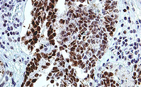 Wilms' Tumor