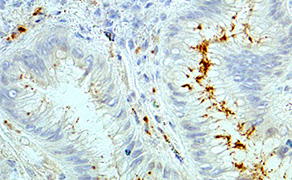 Helicobacter Pylori