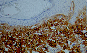 COL1A1